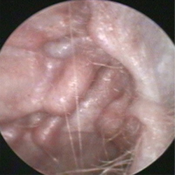 正常な耳介と耳道1