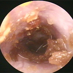 外耳炎の耳道1